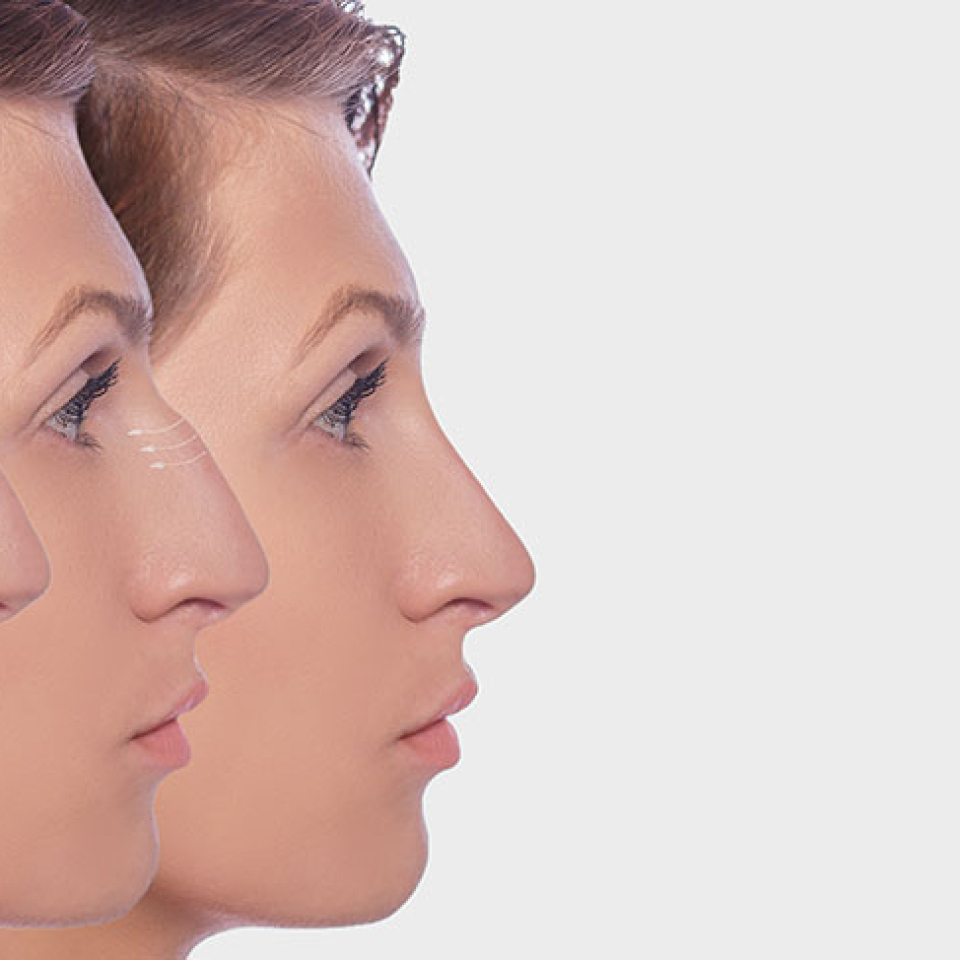 3D ile Burun Estetiği